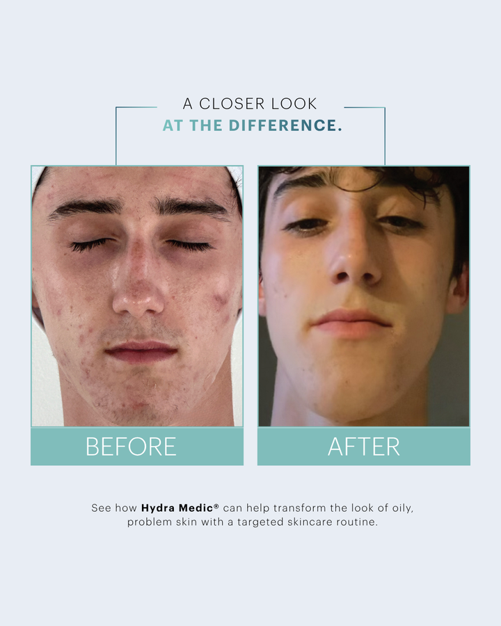 FREE Hydra Medic Astringent w/ Purchase of Hydra Medic Face Wash & Hydra Medic Sea Mud Perfecting Mask