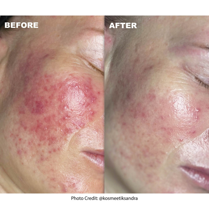 Red-Out® Facial With Seaweed Extract And Silver